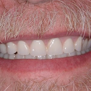 The Foehr Group Dentures - After