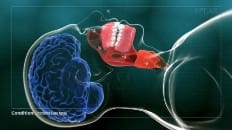 Obstructive Sleep Apnea 001