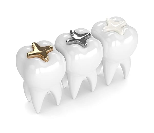 3D illustration comparing composite, amalgam, and gold dental filling materials