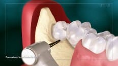 Surgical Extraction (3rd Molar) 002
