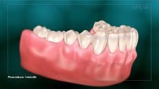 Periodontitis 001