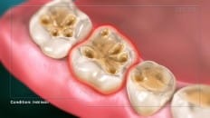 Dental Erosion 002