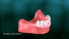 Removable Partial Dentures 001