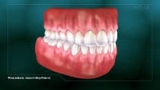 Composite Filling (Posterior) 006