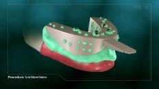 Screw Retained Dentures 005