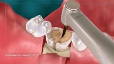 Surgical Extraction (Other) 003