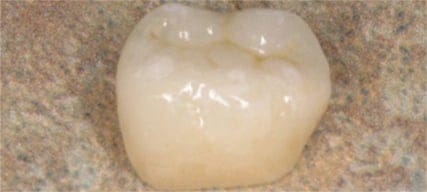 Cerec-Crown1