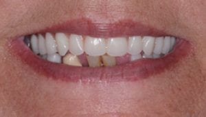 Dental Implants Before