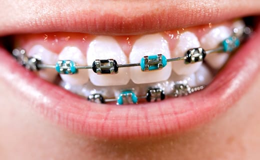 How to Clean and Maintain Your Braces How to Clean and Maintain Your Braces