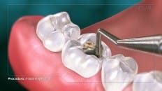 Amalgam Filling (Posterior) 004