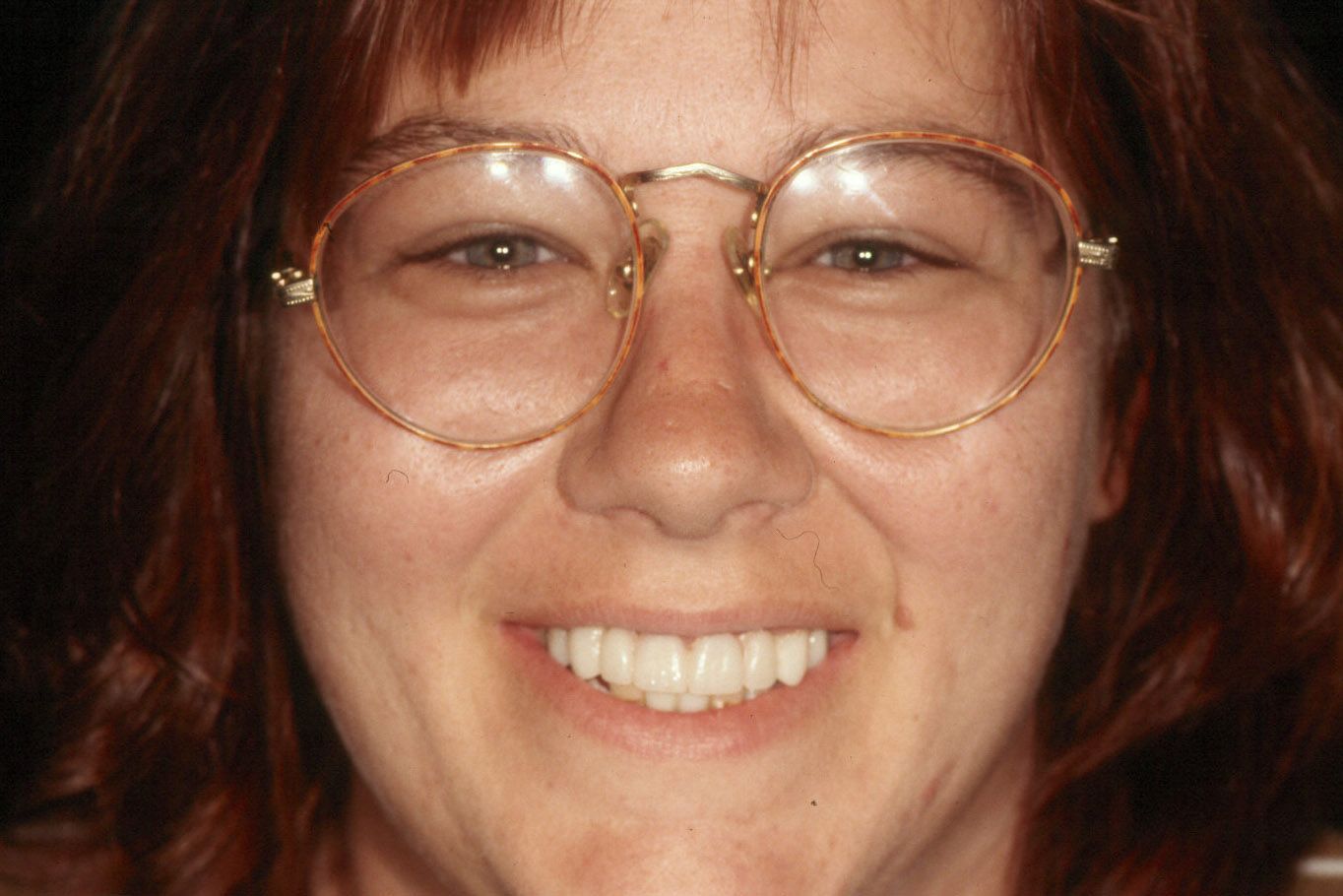 Rasner Smile gallery after 15