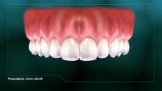 Veneers image 006