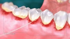 Gingivitis 004