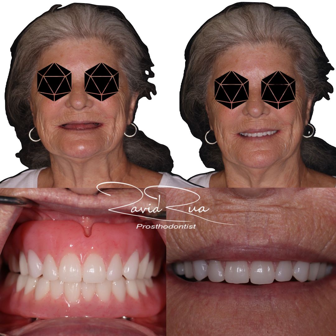 TC Cape Coral Case 9 Top and Bottom implants/bar supported overdentures
