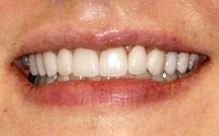 18. Patient EF (10 teeth)_ Porcelain crowns on upper 10 teeth After