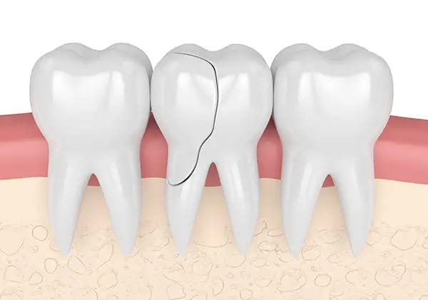 Cross-section of cracked tooth showing fracture requiring dental treatment Cross-section of cracked tooth showing fracture requiring dental treatment