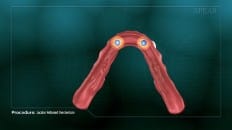 Locator Retained Overdenture 005