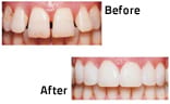 What are Lumineers®?