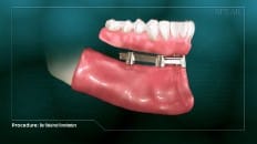 Bar Retained Overdenture 008