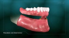 Locator Retained Overdenture 010
