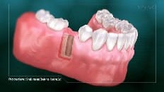 Single Implant (Posterior- Healing Cap) 002