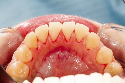 What is the Main Cause of periodontal Disease?