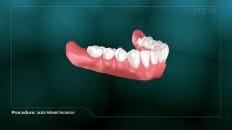Locator Retained Overdenture 004