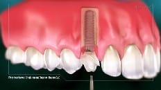 Single Implant (Anterior - Healing Cap) 005