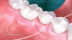 Bridge Versus An Implant 005