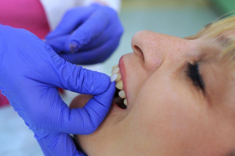 My Veneer Fell Off! 5 Simple Steps to Take Next My Veneer Fell Off! 5 Simple Steps to Take Next