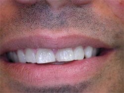 Bonding & Whitening after