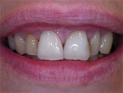 Veneers before