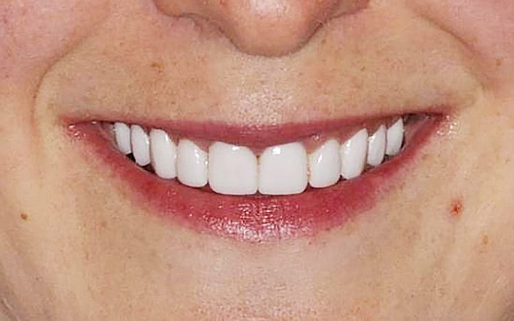 15. Patient KG (10 teeth)_ Porcelain veneers on upper 10 teeth After