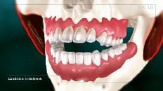 Anterior Open Bite 003
