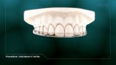 Occlusal Appliance For Tooth Wear 004