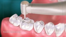 Amalgam Filling (Posterior) 003