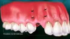 Bone Graft With Immediate Implant Placement 006