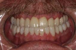 Restoration after