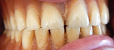 Before dentures Burke DrPrice