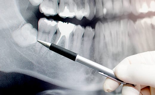 Monitor Your Wisdom Teeth to Maintain Good Dental Care Monitor Your Wisdom Teeth to Maintain Good Dental Care