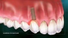 Peri-Implant Mucositis 001