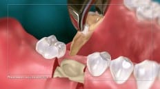 Surgical Extraction (Other) 004
