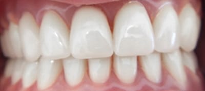 After dentures Burke DrPrice