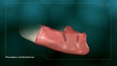 Screw Retained Dentures 004