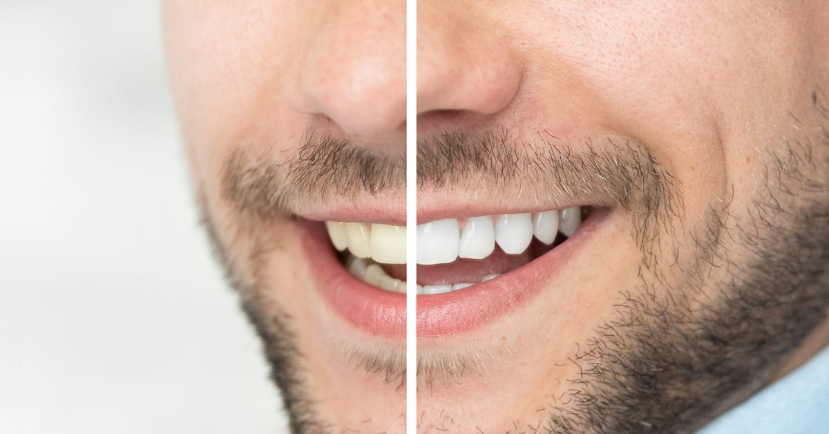 Reasons and Remedies for Tooth Discoloration Reasons and Remedies for Tooth Discoloration