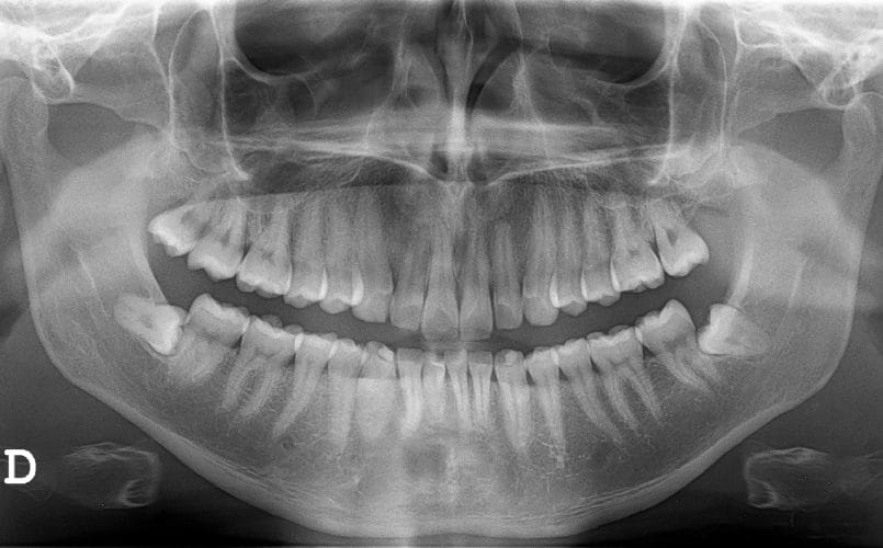 Digital Dental Sensors – The New X-Ray Technology