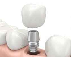 Look What Dental Implants Can Do!