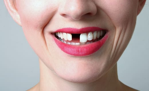 The Trouble with Impacted Wisdom Teeth