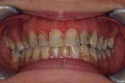 Full Arch Porcelain Restoration before