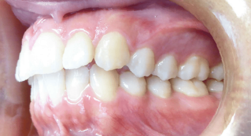 Left Bite for Virtual Orthodontic Consultation